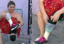 Cansada de esperar por prótese da prefeitura, mulher improvisa uma com liquidificador